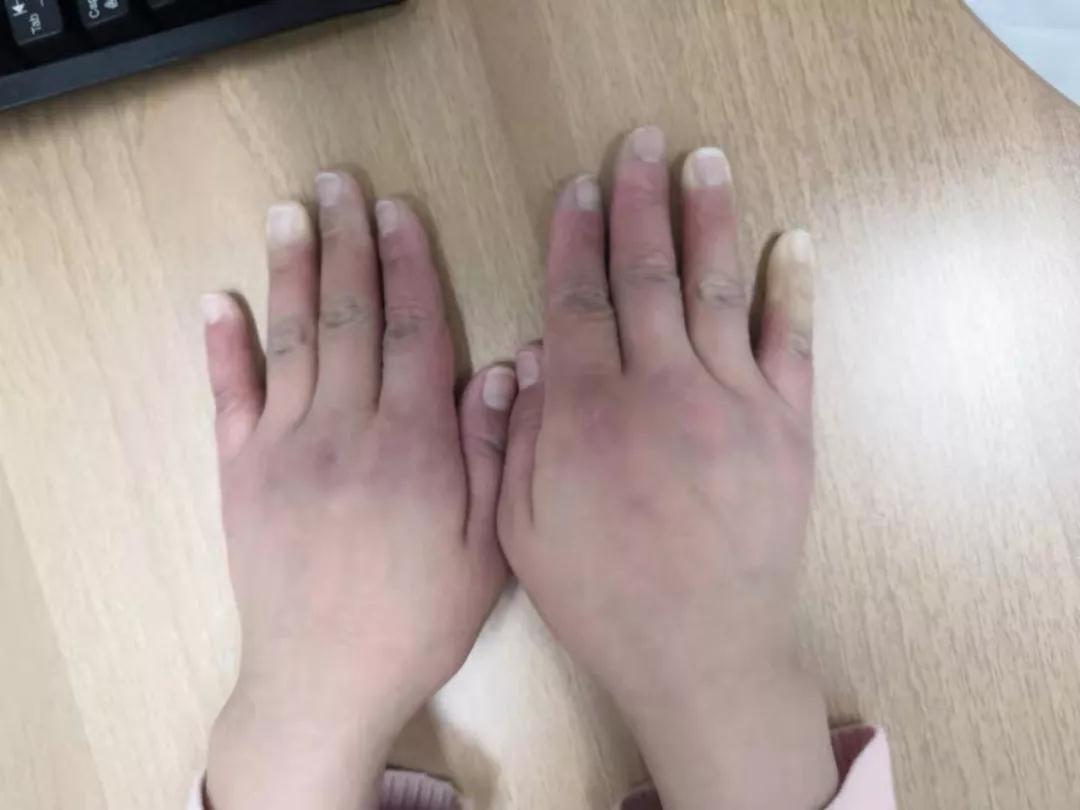 “手指、腳趾發(fā)白、發(fā)紫……”這些“小毛病”千萬別大意