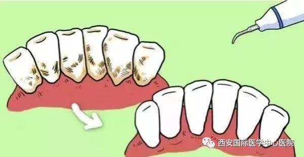 牙齒上的黃斑好難看，三招告訴你如何預防氟斑牙