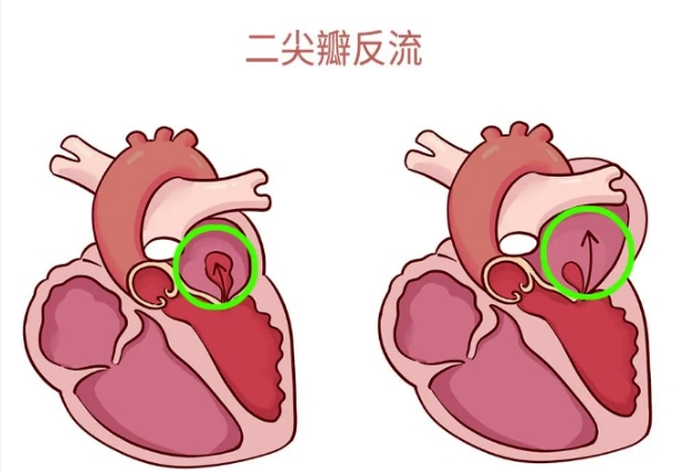 體檢報(bào)告里的心臟瓣膜返流，你讀懂了嗎？